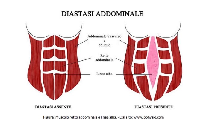 diastasi addominale